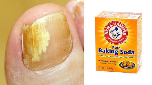 Toe fungus